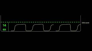 CO2 Capnography monitoring [upl. by Froh996]