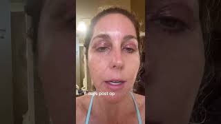 Eyelid surgery recovery  blepharoplasty  6 days after upper lid surgery [upl. by Kohl]