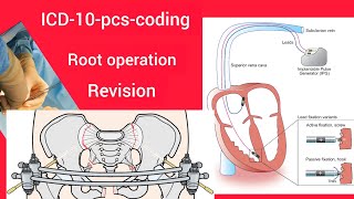 IP DRG trainingICD10PCS codingRoot operation Revision [upl. by Anyala]