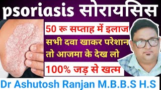 psoriasis ka ilaj 👉सोरायसिस को जड़ से खत्म करें 👉50 रुपये में👉क्यों नहीं ठीक होगा 💯 ठीक होगा [upl. by Elnar]