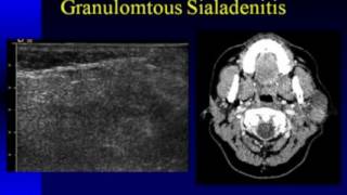 Ultrasound Imaging of the Salivary Glands [upl. by Joyann]