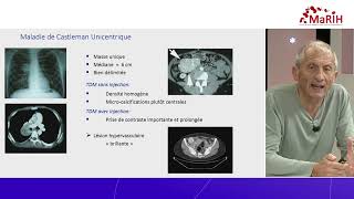 REPLAY 🩸 WEBCAST MaRIH  Maladie de Castleman amp Anatomopathologie [upl. by Draillih779]