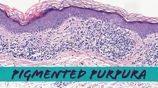 Pigmented Purpuric Dermatosis Schamberg disease lichen aureus etc pathology dermatology [upl. by Guidotti]