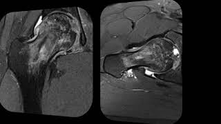 Bilateral Hip AVN [upl. by Ardnak]