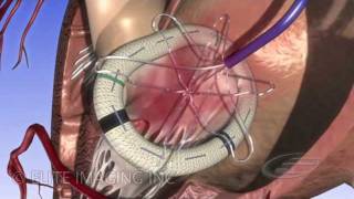 Mitral Heart Valve Ring  Medical amp Scientific Video Production [upl. by Htiekal283]