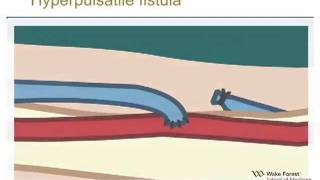 Physical Examination of Arteriovenous Fistula [upl. by Rao]