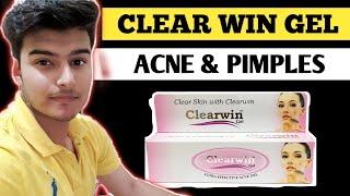 MY ACNE STORY CLEARWIN GEL REVIEW  CLEARWIN GEL I USED THIS FOR 1 MONTH ACNE STORY  CLEAR SKIN [upl. by Aihsotan]