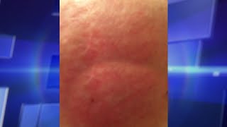 Skin Rash Leads to Shocking Diagnosis [upl. by Sairu]