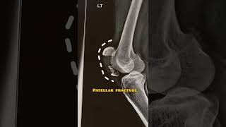 Patellar fracture 🦴 humanbody fracture bones [upl. by Latham]