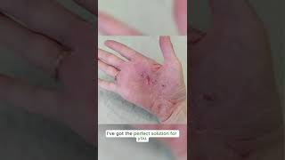 Hand eczema requires deep moisturization Try this Zudaifu 3rd generation eczema zudaifu [upl. by Enidualc]