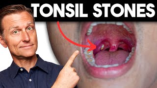 Tonsil Stones Removing the Deeper Cause [upl. by Octavla]