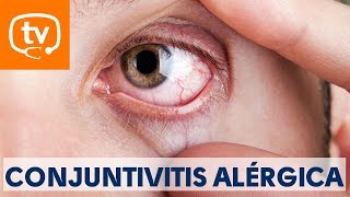 Claves sobre la conjuntivitis alérgica [upl. by Jobie252]