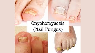 ONYCHOMYCOSIS symptoms treatment and prevention [upl. by Serena]