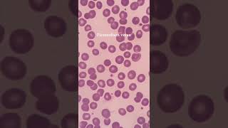 Plasmodium vivex Smear science pathologylaboratory microbiology [upl. by Aihtniroc]