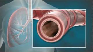 Animation of Bronchial Thermoplasty BT with the Alair® System [upl. by Anod746]