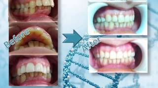 العلاج التقويمي للبروز الشديد في الأسنان العلوية Orthodontic treatment of severe protrusion [upl. by Bolling193]