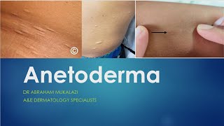 ANETODERMA BY DR ABRAHAM dermatology scarystory skincareeducation funny ANETODERMA [upl. by Htesil]