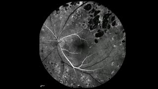 Fluorescein Angiography of the Left Eye at Baseline and at 3Year FollowUp [upl. by Negem]