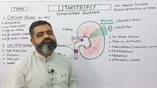 Lithotripsy UrduHindi medium profmasoodfuzail Extracorporial shock wave lithotripsy [upl. by Connor]