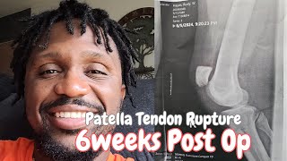 Patellar Tendon Rupture Surgery 6 Weeks Post Op [upl. by Darken500]