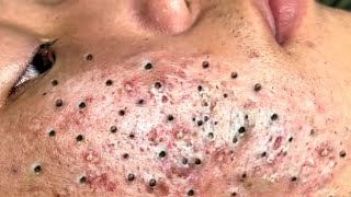 Blackhead Removal With Sac Dep Spa 100074085 [upl. by Neeneg]