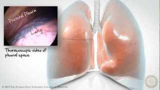 Pleural Space Part 1 of 3 HD [upl. by Akinorev175]