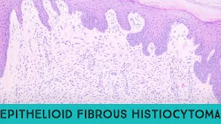 Epithelioid fibrous histiocytoma benign ALK1 skin tumor ALK gene fusion pathology dermpath [upl. by Creedon]