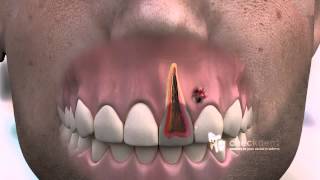 How to treat a dental Fistula [upl. by Christi]