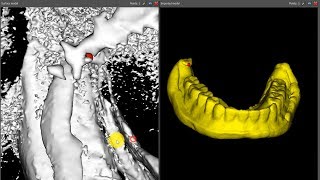 InOffice 3D Printed LODI Surgical Guide Technique with Blue Sky Plan amp Radiopaque PVS [upl. by Frager]