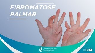 Fibromatose palmar o que é  Dr Fernando Moya CRM 112046 [upl. by Cort]