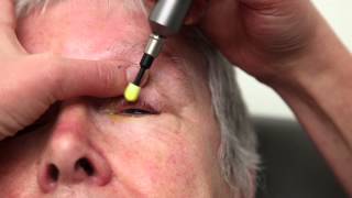 Blepharitis Treatment That Really Works Blephex Eyelid Cleaning [upl. by Kellda]