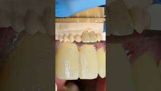 Signature Zirconia Crowns ​⁠EnvisiontecMain envisiontec lsk121shorts dentist [upl. by Eittik]