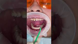 Porcelain veneers procedure  dental veneers procedure step by step  smile makeover  Dr Yazdan [upl. by Melisandra]