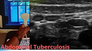 Abdominal Kocks TBthe great masquerader on Ultrasound [upl. by Elirpa]