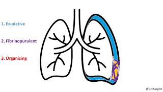 Empyema and Pleural Effusions [upl. by Steffen]