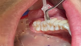 NEW Proximal Curodont Tutorial Hydroxyapatite Remineralization Minimally Invasive Cavity Prevention [upl. by Armillia731]