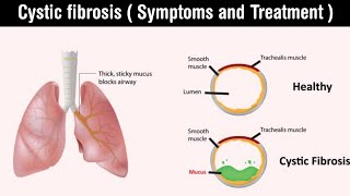 Cystic fibrosis  gene mutation  symptoms and treatment of cystic fibrosis  in Hindi [upl. by Rondi200]