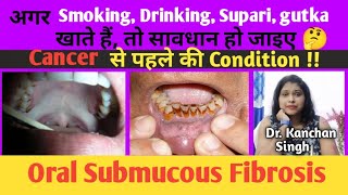 Osmf treatment in hindi Oral submucous fibrosis cause and treatment Dr Kanchan Singh [upl. by Neoma]