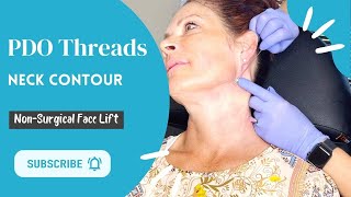 PDO Threads Neck Lift  Belladerm MedSpa [upl. by Aicekat]