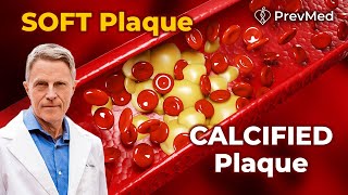 The Difference between Soft plaque and Calcified plaque [upl. by Maryanne744]