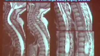 Imaging Patients with Myelopathy [upl. by Ynnor331]