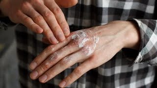 علاج الاكزيما في اليدين  Hand eczema treatment [upl. by Bjork698]