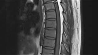 Epidural lipomatosis [upl. by Aerahs]