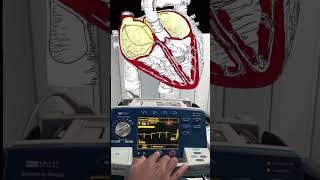 Atrial Fibrillation Cardioversion Video and Animation 🫀🔌 medical cardiology [upl. by Eiryt]