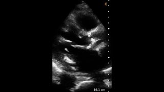 Aortic Stenosis – Ultrasound Image Interpretation [upl. by Yram]