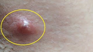 how to get rid of ingrown hair cyst permanently at home [upl. by Esilec749]