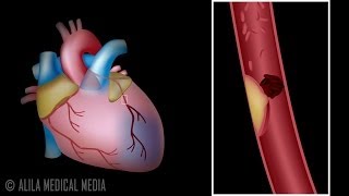 Myocardial Infarction and Coronary Angioplasty Treatment Animation [upl. by Eramat]