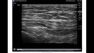 US GUIDED SAPHENOUS NERVE BLOCK BELOW THE KNEE [upl. by Auqeenahs853]