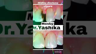 Midline diastema closure with composite restoration 🦷 📞 7419001200 [upl. by Akinhoj]