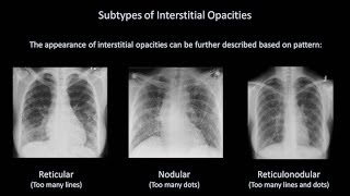 How to Interpret a Chest XRay Lesson 7  Diffuse Lung Processes [upl. by Ignace]